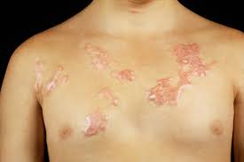 How to get rid of keloid scars. 10 Natural Remedies For Keloids