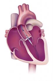 Stenoza aortică reprezintă îngustarea orificiului acestei valve. 7 Lucruri Despre Tavi Procedura De Inlocuire PercutanÄ A Valvei Aortice Cardiologie BucureÈti Promediq