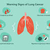 A sputum culture (mucus coughed up from the. 1
