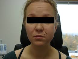On the first postoperative day, the left side of the patient's face was... 