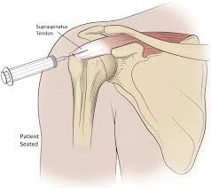 Image result for Shoulder Injection