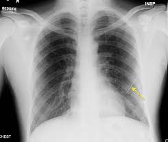 Image result for Chest Trauma