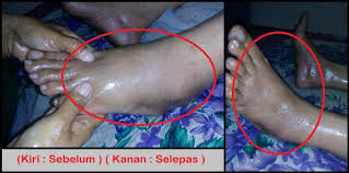 Check spelling or type a new query. Urutan Tradisional Muslimah Penaga Urut Kaki Terseliuh Kalau Terjatuh Dan Kaki Terpelecok Tu Cepat Cepat La Mai Bagi Kak Za Urut Jangan Biaq Sampai Masuk Angin Dan Kaki Bengkak Macam Ni