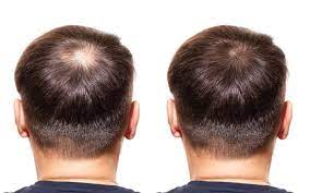 Instead, it can accumulate to toxic levels in your liver and fatty tissue, causing noticeable symptoms. The Best Dht Blockers How They Can Combat Hair Loss Skinkraft
