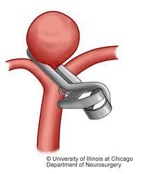 A aorta é a maior e mais importante artéria de todo o sistema circulatório, já que é responsável por transportar sangue oxigenado para todas as partes do corpo. Aneurisma Cerebral