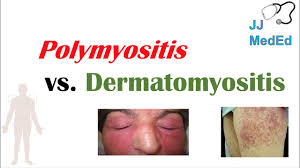Image result for Polymyositis