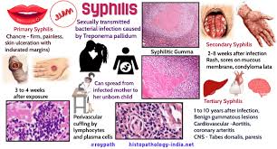 Image result for Primary Syphilis
