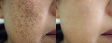 It is often caused due to genetics or a hereditary tendency to develop skin pigmentation easily after any abuse to skin. How Can I Get Rid Of Skin Pigmentation The Temple Skincare Spa