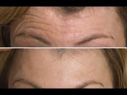 How To Prevent And Reverse Forehead Wrinkles With A Simple 2 Minute Massage Youtube Forehead Wrinkles Wrinkles Remedies Face Forehead Wrinkle Treatment