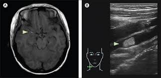 Middle cerebral artery stroke symptoms. Facial Filler Causes Stroke After Development Of Cerebral Fat Embolism The Lancet