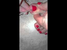 How To Remove An Ingrown Nail Ingrown Toe Nail Ingrown Nail Remove Ingrown Toe Nail
