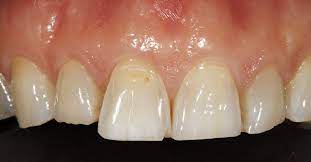 What Causes Worn Teeth Teeth Erosion Treatment Fleet Dentist