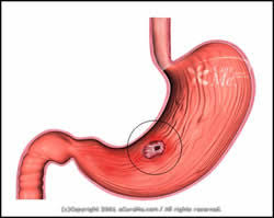 Image result for helicobacter pylori ulcer