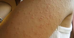 She Had Itchy Red Bumps On Her Arms, But Had No Idea It's A Sign Of This! |  Littlethings.com