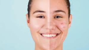 From Diet to Skincare: A Holistic Approach to Overcoming Acne