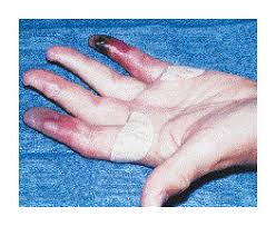 Image result for Dexfenfluramine