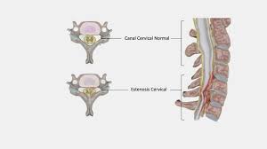 Στένωσις, contraído) es un término utilizado para denotar la constricción o estrechamiento de un orificio o conducto corporal. Estenosis De La Columna Cervical Neurocs
