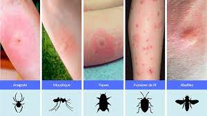 allergie punaise de lit badbugs fr