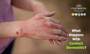 Image result for dermatitis contacta toxica