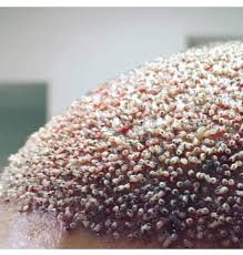 Definitely, ingrown pubic hair cyst comes with itching and the. Infected Hair Follicle Transplant Popping