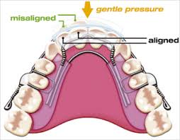 By far, the best benefit of the inman aligner is its speed. Inman Aligner Faqs Stonerock Dental Care