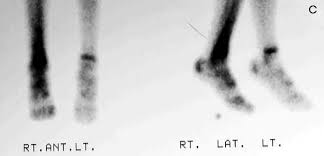 Image result for Osteomyelitis Bone Scan