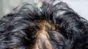 Cause secondarie, come stress, inquinamento atmosferico, abuso di shampoo troppo aggressivi o comunque di pessima qualità compositiva. Oily Hair How To Recognize Them And How To Treat Them Insalaco Clinic