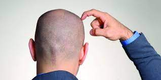 Research shows hair growth can be impacted when you reduce losing and regaining weight over many years can impact your metabolism and hair growth. Weight Loss And Hair Loss Does Losing Weight Make You Go Bald The Bald Gent