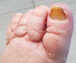 Główne zalety opatrunku to jego dobre przyleganie do rany, wodoodporność, skuteczna wymiana gazowa i. Przez Tego Drania Nie Potrafie Nawet Spac Gabinet Podologiczny Jan Cyrulik