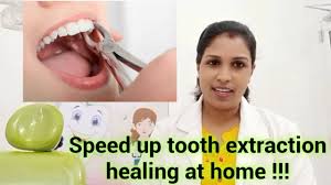 Knowing how to take the necessary precautions before and after the extraction procedure will. Dental Tips Advice After Dental Extraction Speed Up Tooth Extraction Healing At Home Youtube
