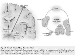 Image result for Thalamic Stimulation