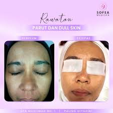 Sofea Medispa Chemical Peeling