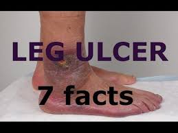 Leg Ulcers 7 Facts About Leg Ulcers You Must Know Leg Ulcers Ulcers Varicose Ulcer