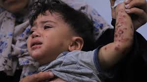 A highly contagious skin disease is spreading across parts of the Gaza Strip