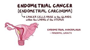 By stage iv, the cancer has grown to involve nearby organs, such as the bladder, or has spread to distant areas of the body. Endometrial Hyperplasia And Cancer Clinical Practice Osmosis