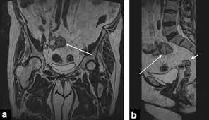 When this is found in the ovary, it is ovarian cancer. Digestive Diseases Mimicking Primary Gynecological Diseases Or With Secondary Gynecological Manifestations Sciencedirect