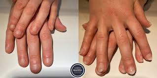 La menace si tu te ronges les ongles, tu auras l'appendicite n'est qu'une rumeur soigneusement. Arreter De Se Ronger Les Ongles Beautiful Nails Louvain