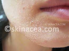 How To Get Rid Of Dry Skin Skinacea Com