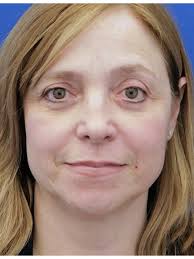 Upper and Lower Blepharoplasty 6658