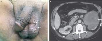 Erfahren sie mehr über definition, ursachen und behandlung oder finden sie erfahrene fachärzte und kliniken für eine. Akute Varikozele Als Zeichen Eines Nierentumors Springerlink