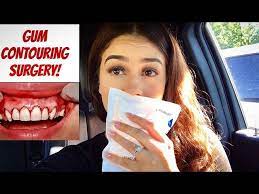 June 4, 2020 · how can we turn an average smile into a dazzling work of art? Gum Contouring Surgery Procedure Vlog My Experience Youtube