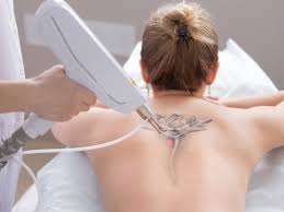Trust the laser specialists at removery to help you find the right laser treatment for your tattoo. The Truth About Laser Tattoo Removal The Aedition