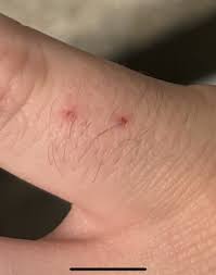 Image result for Bat Bite