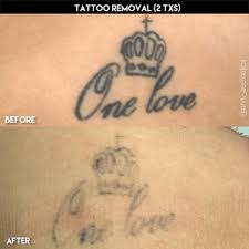 Tattoo removal hair removal skin care. Miami Laser Tattoo Removal Cost Info Arviv Medical Aesthetics