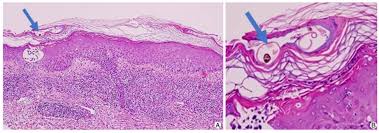 Image result for scabies on genitals