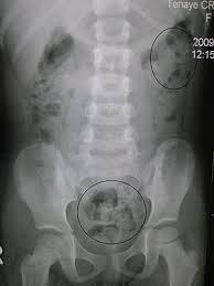 Laxatives are a group of medicines that can treat constipation. Constipation Wikipedia