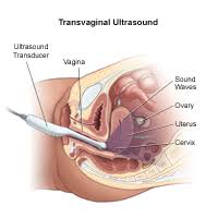Pelvic ultrasound uses sound waves to create an image of the organs in a woman's pelvis. Pelvic Ultrasound Johns Hopkins Medicine