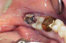 Check spelling or type a new query. Managing Wisdom Tooth Pain At Home Without Seeing A Dentist