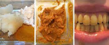 People Are Whitening Their Teeth With Turmeric Obviously We Had To Try It What S Good By V