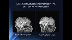 Education Cifasd Collaborative Initiative On Fetal Alcohol Spectrum Disorders